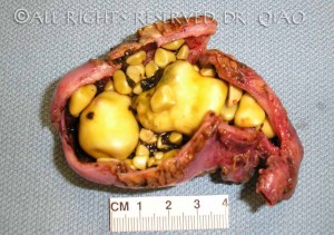 Gallbladder Filled With Gallstones