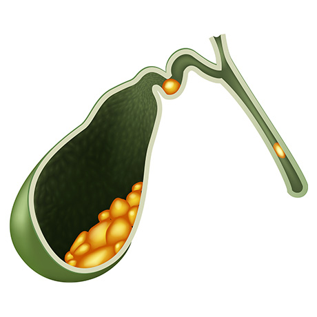 Gallstones Treatment Options That Work