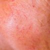 Facial Capillaries Could Be a Signal of Fatty Liver