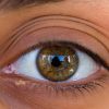 Fatty Liver Disease Symptoms: Lumps of Fat Under the Eyelids
