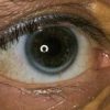 Fatty Liver Symptoms: Fatty Tissue Around The Eyes