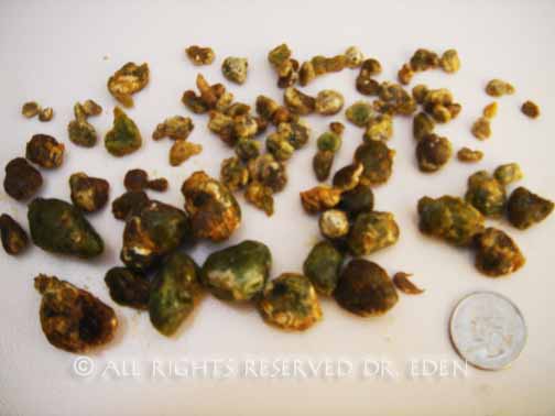 First Bunch of Gallstones