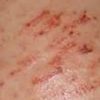 Fatty Liver Symptoms: Skin Rashes