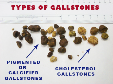 Types of Gallstones