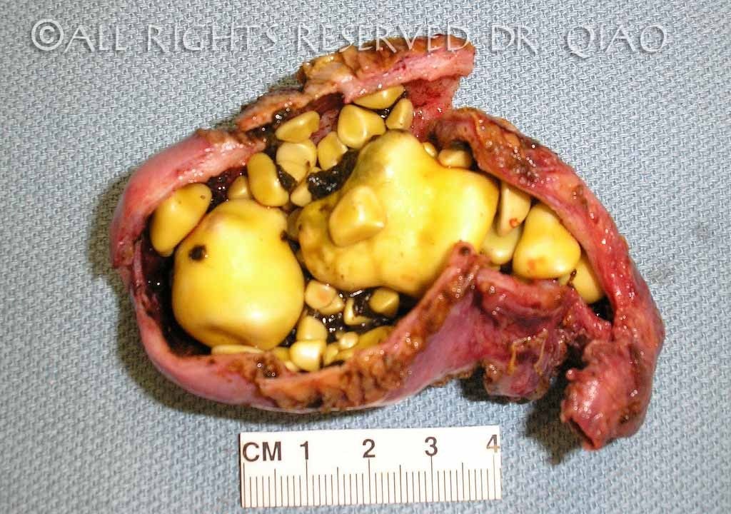 Dissected Gallbladder with Cholesterol Gallstones