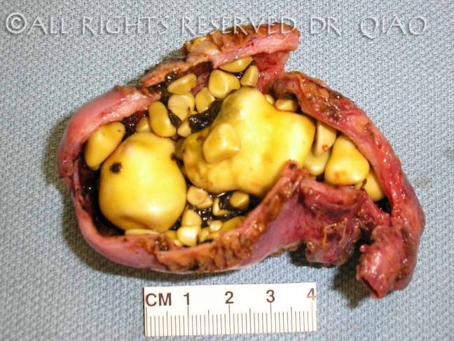 Dissected Gallbladder with Cholesterol Gallstones