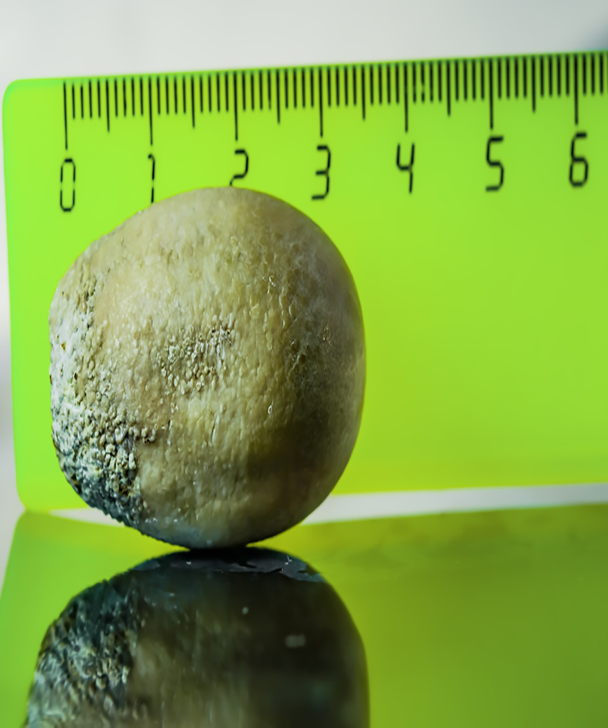 Gallbladder Symptoms: Why Do Gallstones Cause Pain?
